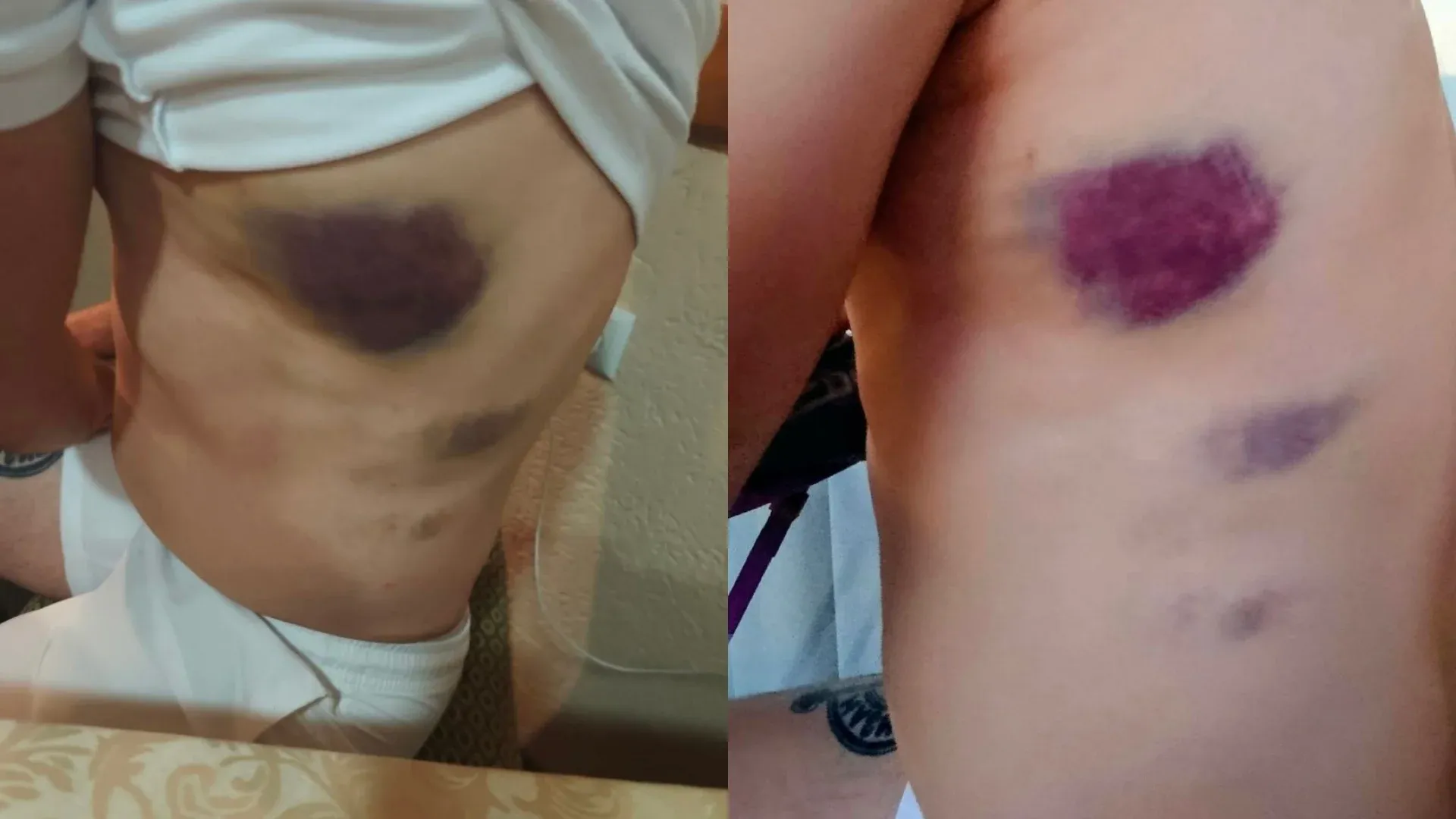 Fotografija modrica koje su zadobili u stanici